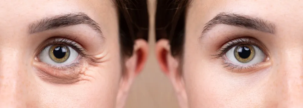 What is Blepharoplasty?