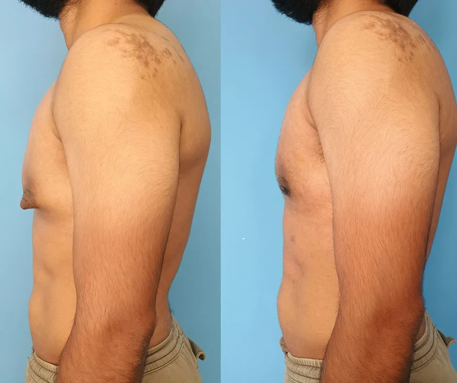 What is Nipple Reduction Surgery?
