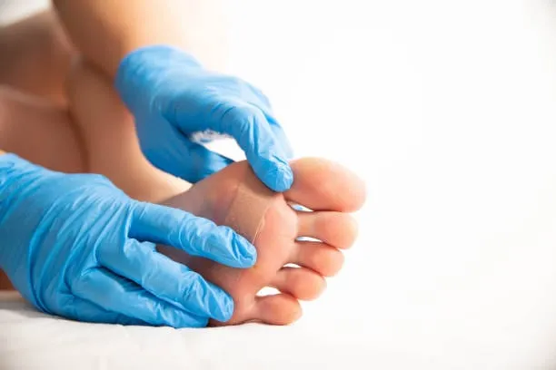 Preventing Verrucas: Expert Tips to Keep Your Skin Verruca-Free