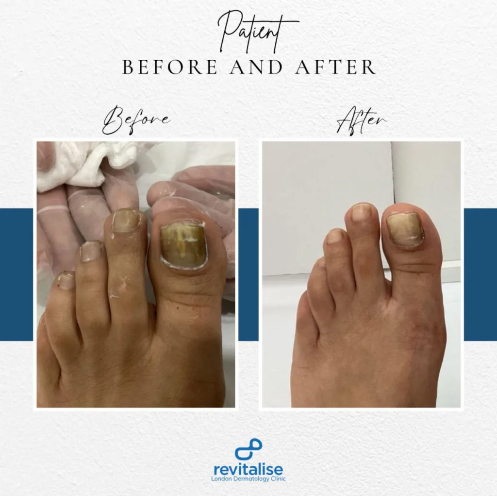 Fungal Nail Diseases Treatment