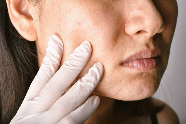 Facial Cyst Removal