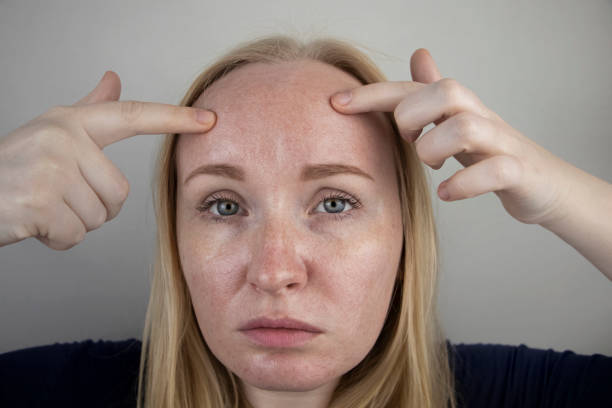 Skin Tag Removal Methods