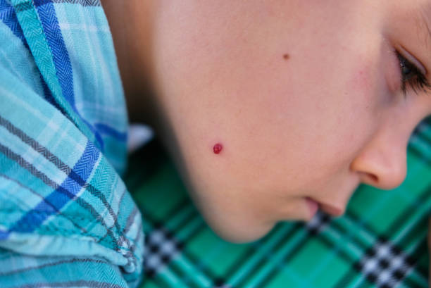 Cherry Angioma Removal