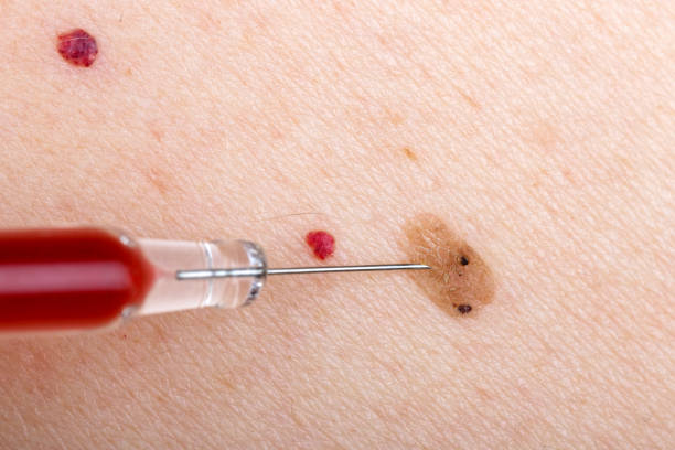 Cherry Angioma Removal