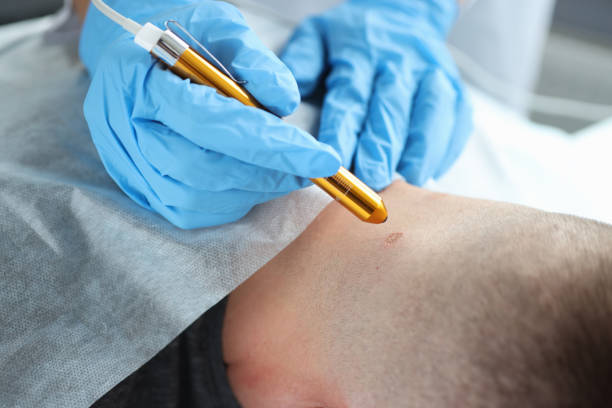 Neck Skin Tag Removal