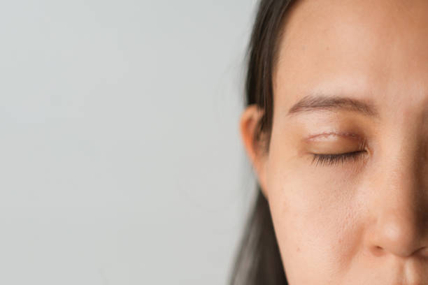 Remove Scar Free Eyelid Skin Tag