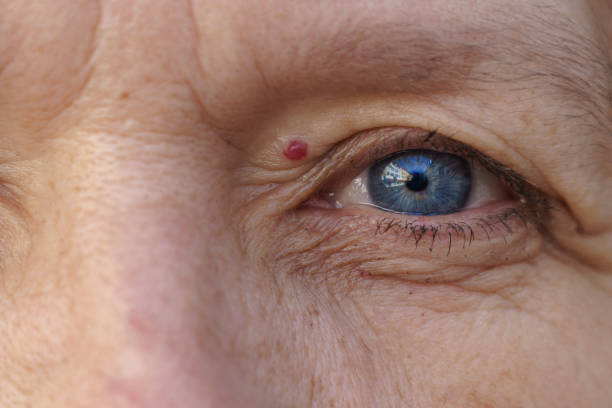 Eyelid Skin Tag Removal