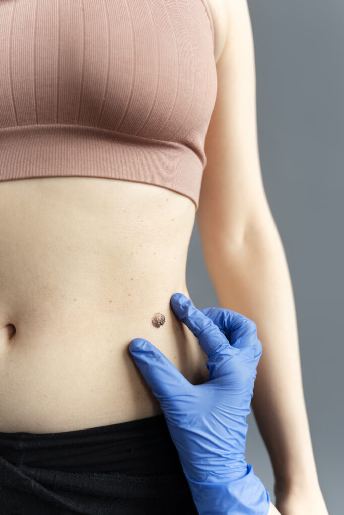 Essential Cyst Removal Aftercare