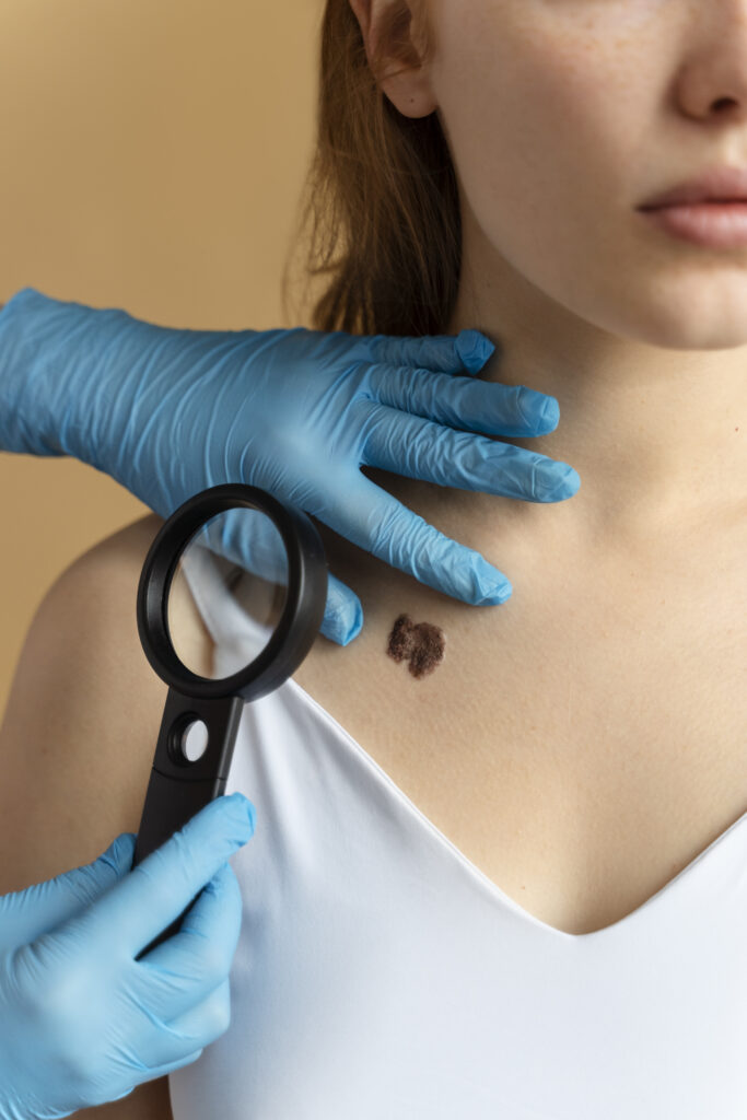 Essential Cyst Removal Aftercare
