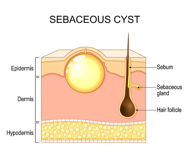 Sebaceous Cyst Removal