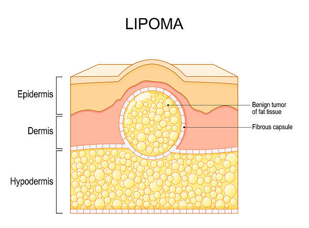 Lipoma Treatment London