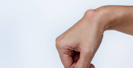 Ganglion Cyst Removal