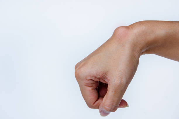Ganglion Cyst Removal