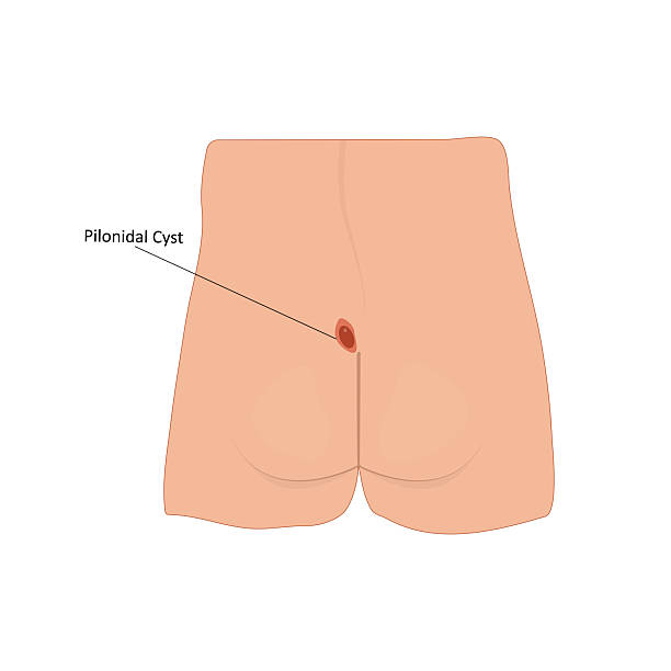 Pilonidal Cyst Removal 